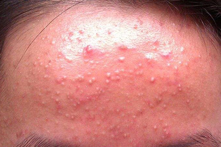 痘痘肌很多闭口用什么产品,预防痘痘闭口的精华