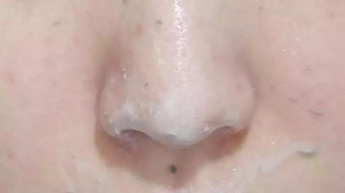 洗脸清洗黑头,洗脸清洁去粉刺