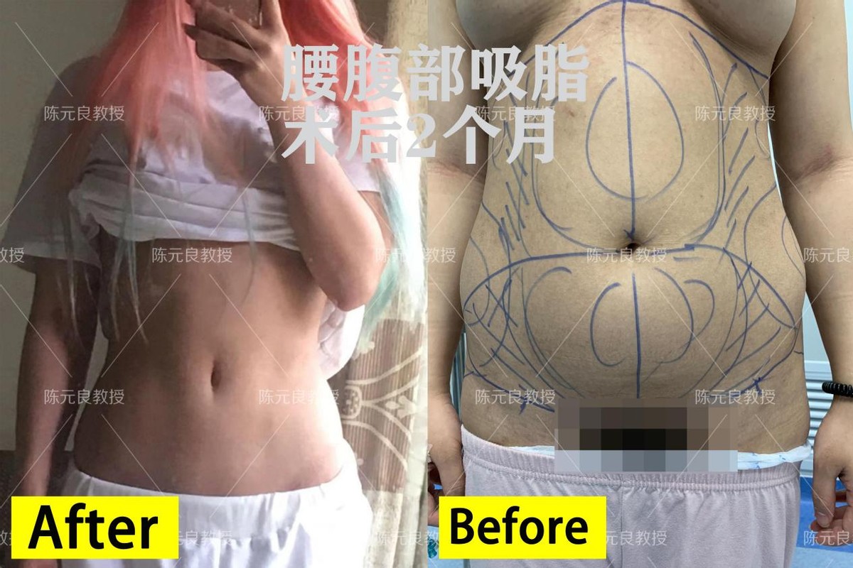 想吸脂减肥具体需要怎么做,想做个吸脂去哪家医院