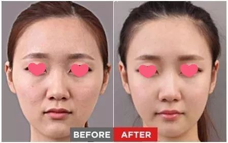 这辈子都不要去碰的四个医美项目,40岁后医美项目这样选