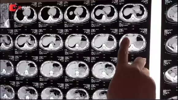 24岁小伙健身逞强脏器撕裂事件,小伙健身导致肌肉撕裂