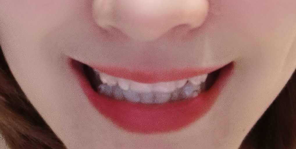 记录我的牙套日记,牙套日记日常