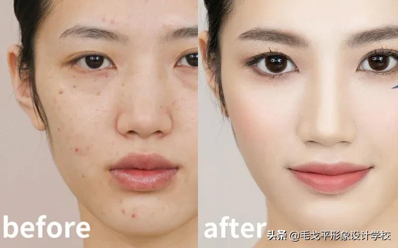 后期如何提升脸部平整度,凹陷脸如何变饱满
