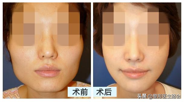下颌角大瘦脸前后对比,下颌角宽的脸方怎么达到视觉效果