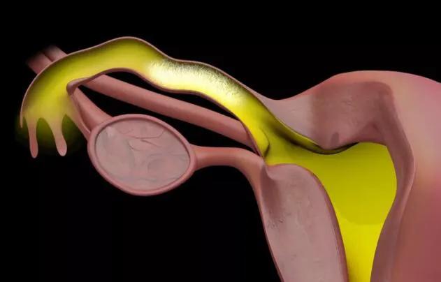 三亚妇幼保健院输卵管造影无痛,石家庄哪个医院有无痛输卵管造影