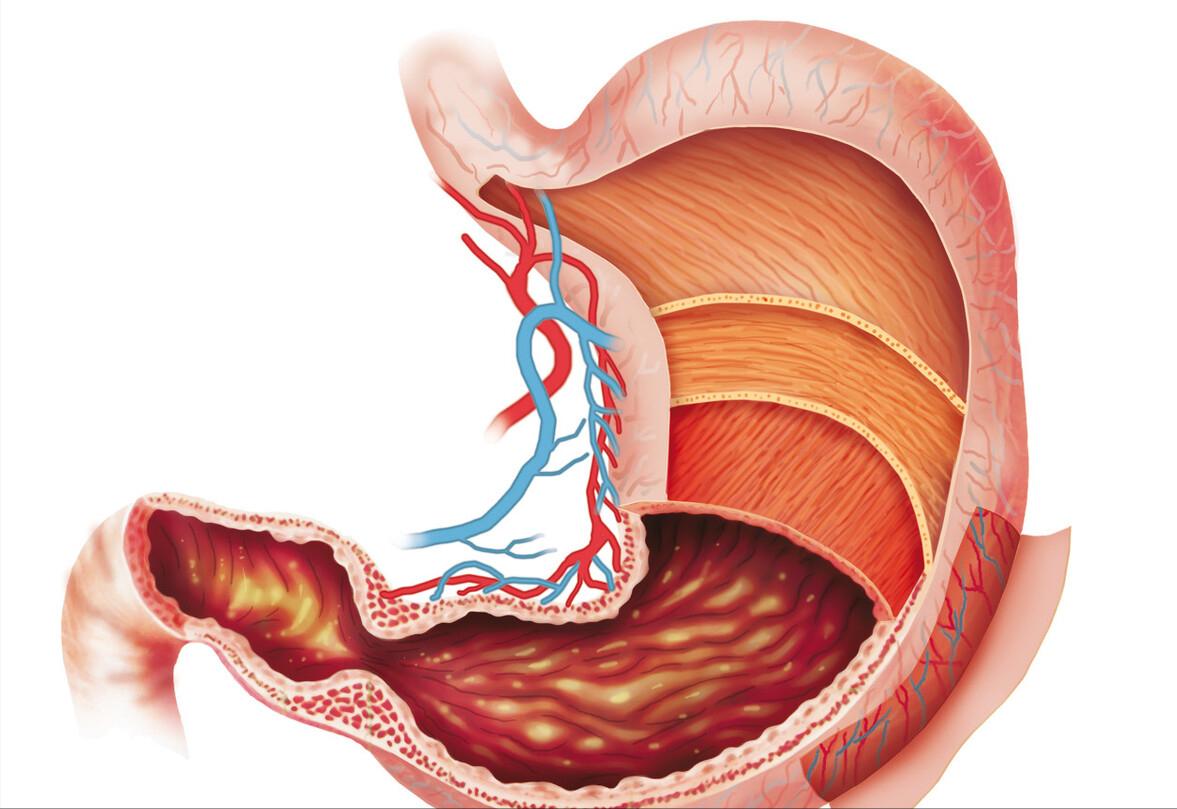 胃有湿气如何治疗吃什么药,胃有湿气吃什么药能治疗