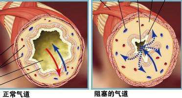 哮喘可防、可控、可治疗