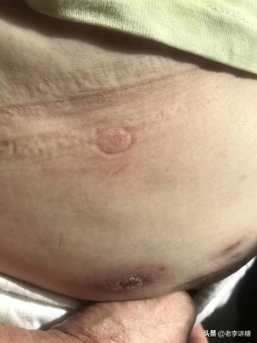 无针头胰岛素注射器哪个耗材实惠,无针注射胰岛素糖友的福音