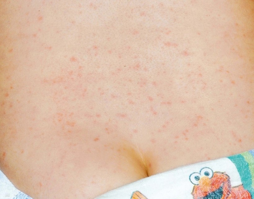 儿童食物过敏怎么办最快最有效,儿童蛋白过敏吃什么食物好