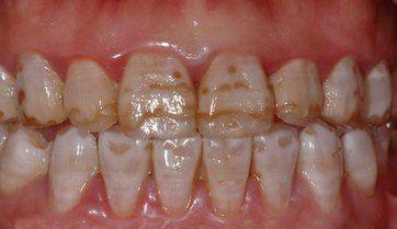 牙齿变黑是口腔癌吗,牙齿变黑了是蛀牙吗