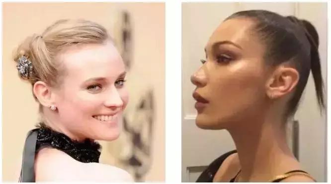 发际线高头发稀疏掉头发怎么拯救,发际线后移的头发还能长出来么