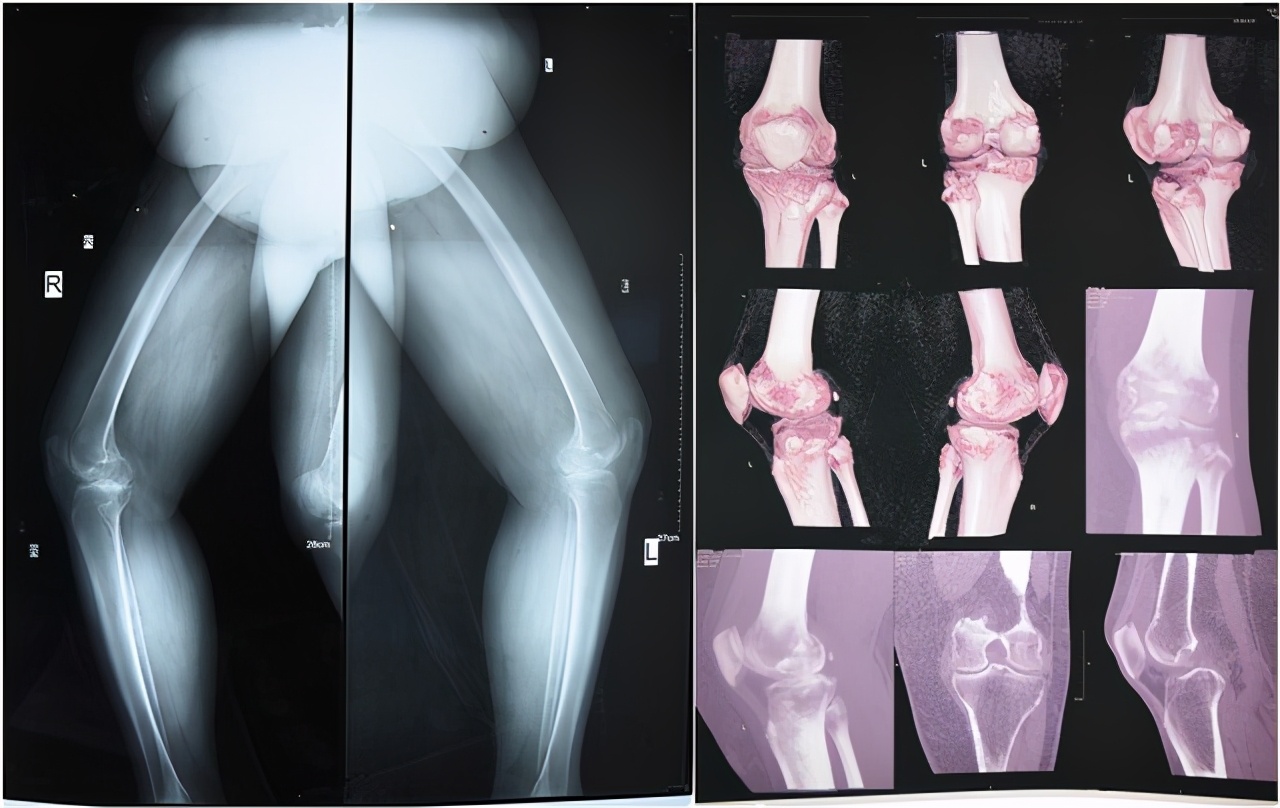 膝盖关节炎疼痛近十年,双膝骨性关节炎保守治疗方法