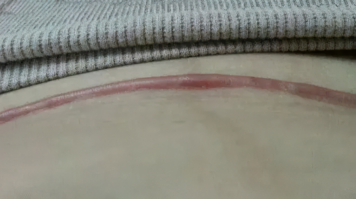 剖宫产疤痕增生用什么药膏能祛疤,剖宫产疤痕又疼又痒怎么办