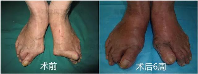 大脚骨怎么做手术好得快,什么样的大脚骨需要手术