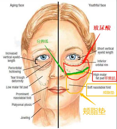 张歆艺用的什么填充脸部,张歆艺填充脸部前后对比