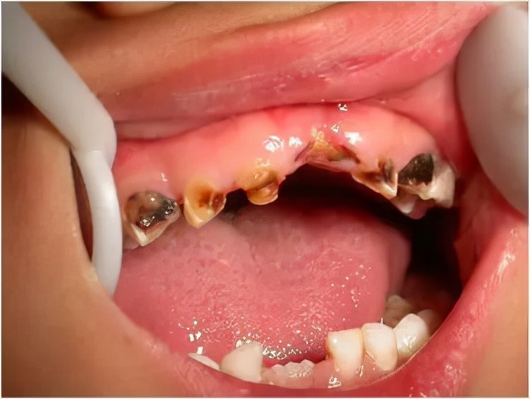 宝宝牙齿烂了怎么办最快的方法,保护孩子牙齿的方法和建议