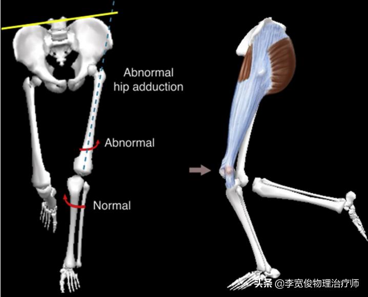 老生常谈跑步膝:髂胫束综合征(ITBS)