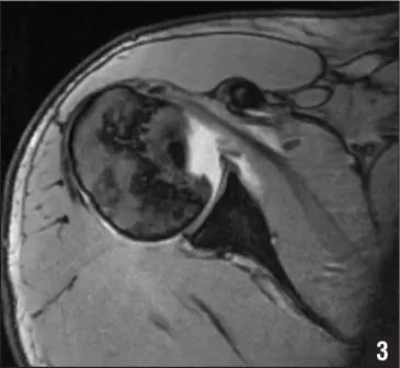 所有骨折都叫什么名字,骨折的名称有哪些