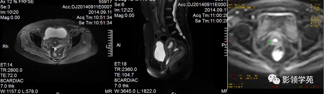 宫颈癌mri诊断,宫颈癌的mr扫描技术