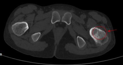 股骨颈肿瘤微创,中医院骨二科