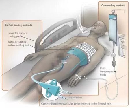 低温治疗的持续时间,低温疗法降温要求