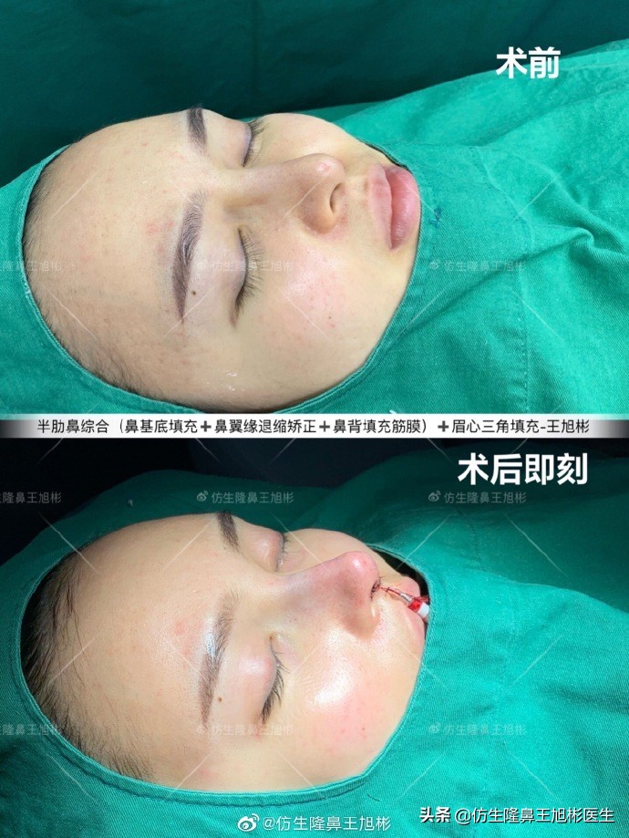 鼻翼缘退缩要如何矫正|王旭彬隆鼻
