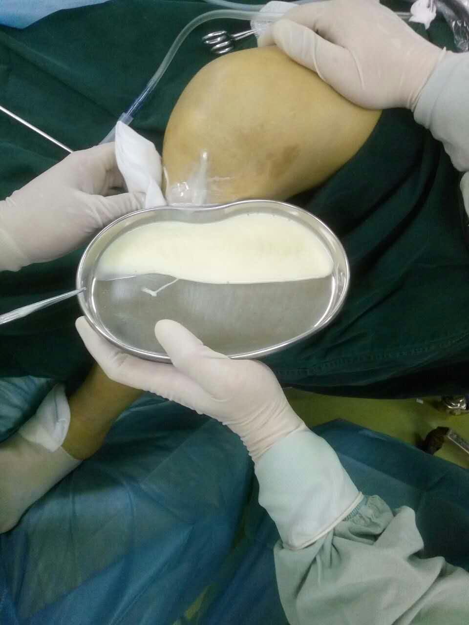 膝盖积水用烤灯能烤好吗?粗盐呢?医生:明确诊断针对治疗是关键