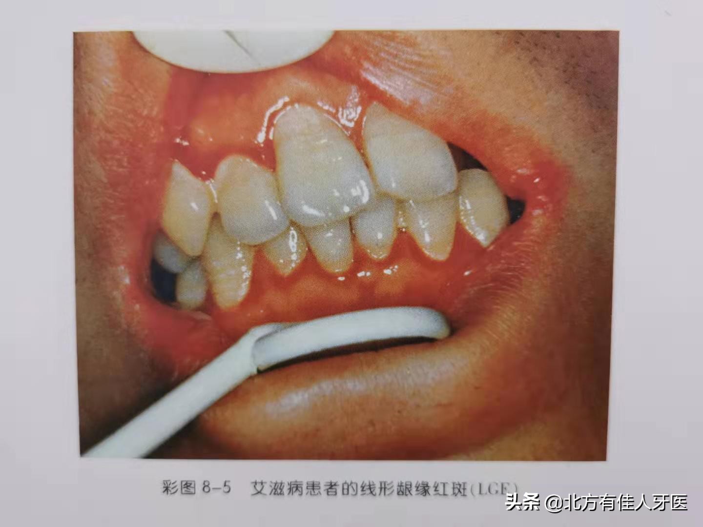 一张嘴就能看出是否得艾滋病,你知道怎么诊断和鉴别诊断吗?