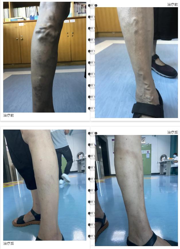 静脉曲张做激光微创手术能报销吗,静脉曲张做激光微创好吗