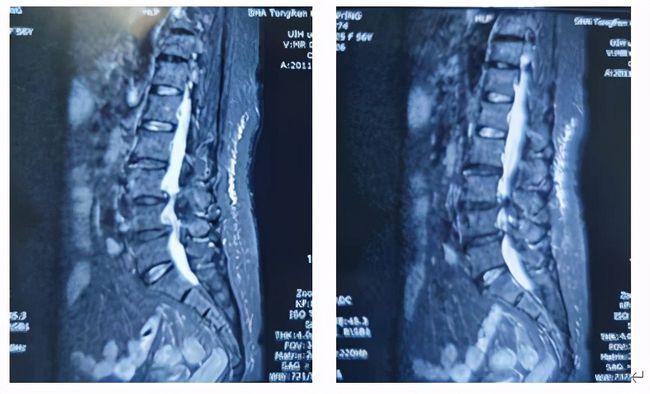腰椎管狭窄有滑脱能做微创吗,腰椎滑脱椎管狭窄可做微创吗