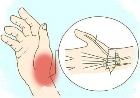 腱鞘炎手指解说图,腱鞘炎介绍