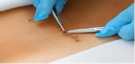 术后拆线时间口诀,粉瘤术后几天拆线