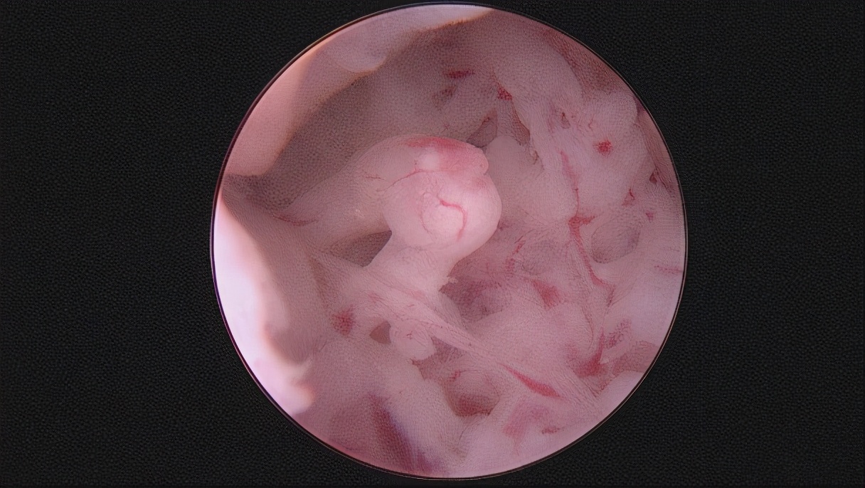 安徽宫腔镜手术专家排名,安徽省立宫腔镜哪个医生做的好