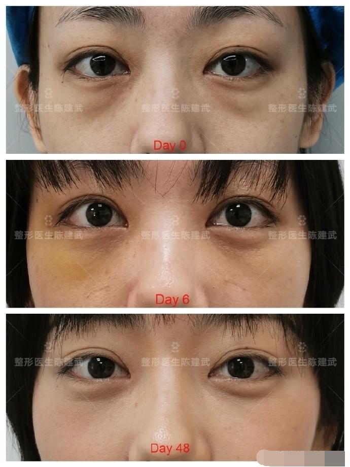 女人眼袋整容失败,30岁后女人去眼袋微整效果图