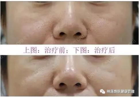 脸部皮肤严重缺水怎么调理,皮肤油光暗沉怎么办