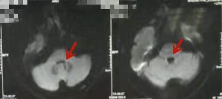 水电解质紊乱补液案例分析,怎么快速纠正电解质紊乱