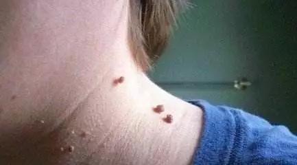 如果你皮肤有各种斑困扰着你,皮肤里面有没有冒出来小颗粒