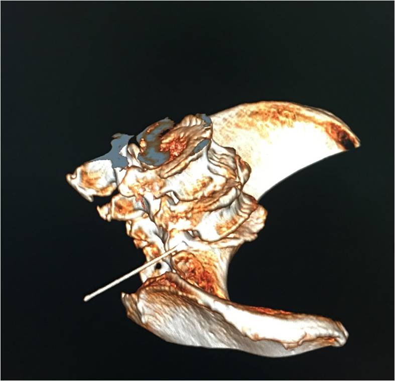 极外侧型腰椎间盘突出微创治疗,超声可视化针刀治疗腰椎间盘突出