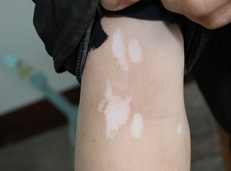 白癜风最快扩散方法,白癜风扩散期怎么治疗最快