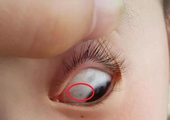 孩子眼白有小黑点是什么原因,儿童眼白有黑点是什么原因