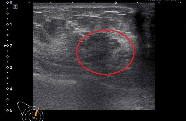 乳房有钙化点忌吃什么,乳房有钙化灶吃什么药好