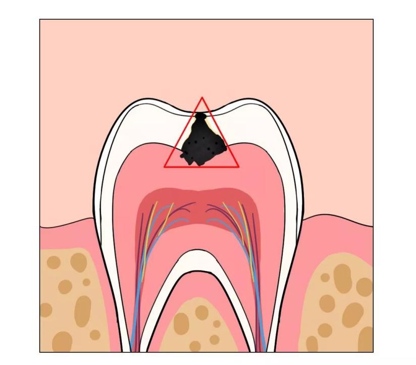 牙齿大牙上有黑点怎么回事,补完牙的牙齿有黑点