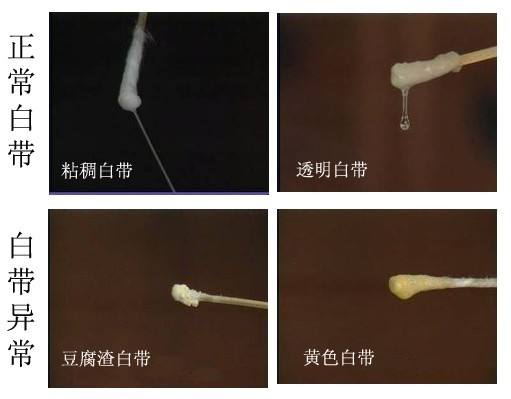 孕期外阴瘙痒会有什么影响吗,孕期白带一直绿色外阴瘙痒