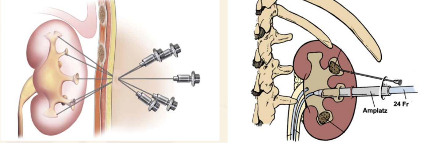 鹿角型结石最严重的后果,疯狂的石头肾脏