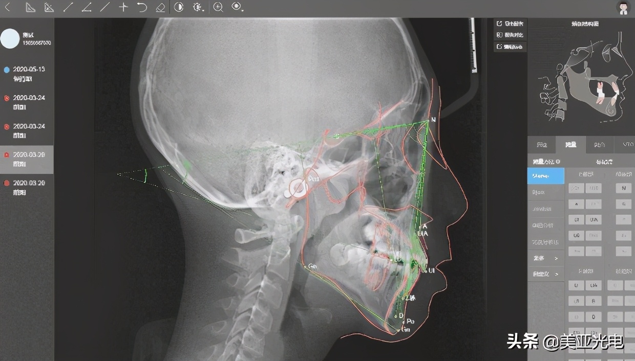 美亚口腔cbct全新局部ct功能上线,口腔cbct最好的品牌
