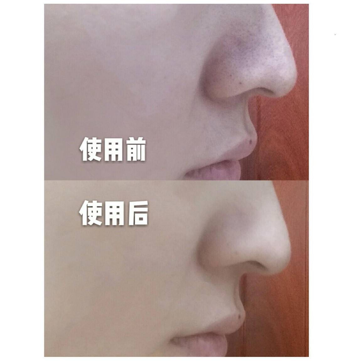 刷酸到底好不好,美容刷酸的副作用是什么