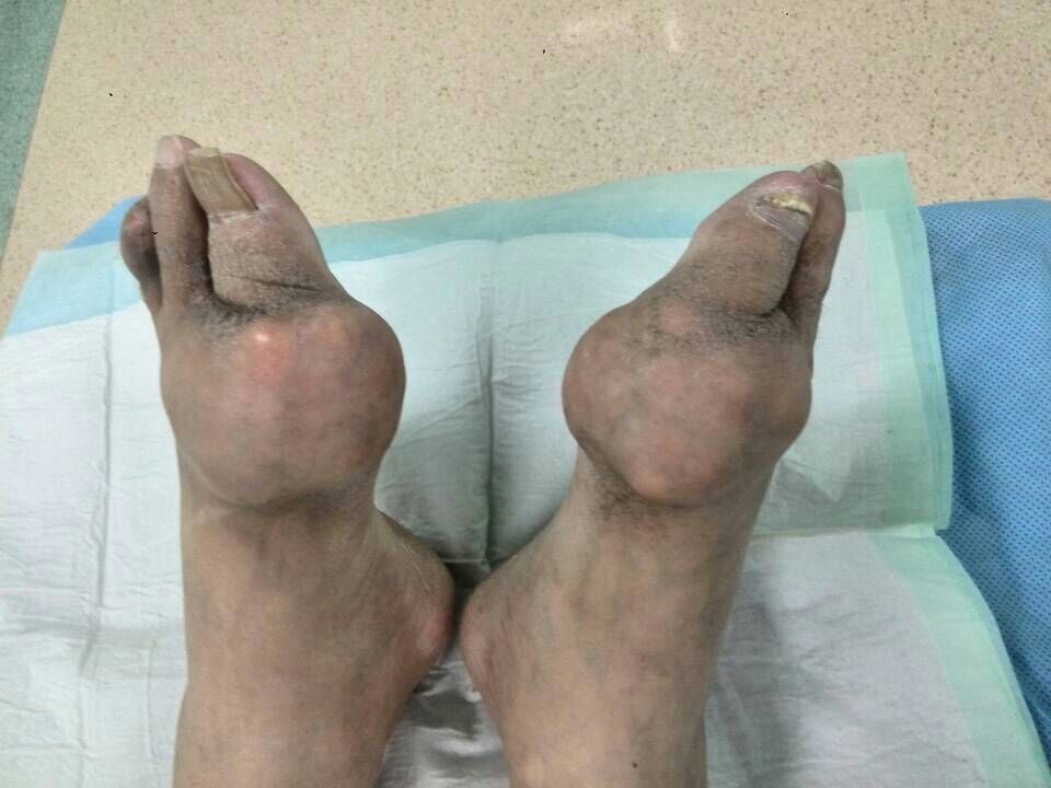 痛风发作居家如何处理？