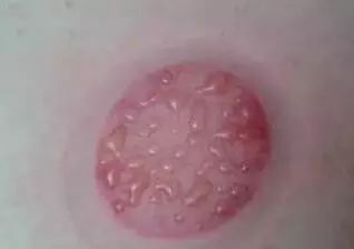 一看就会手把手教拔罐疗法,学拔罐视频教程全集