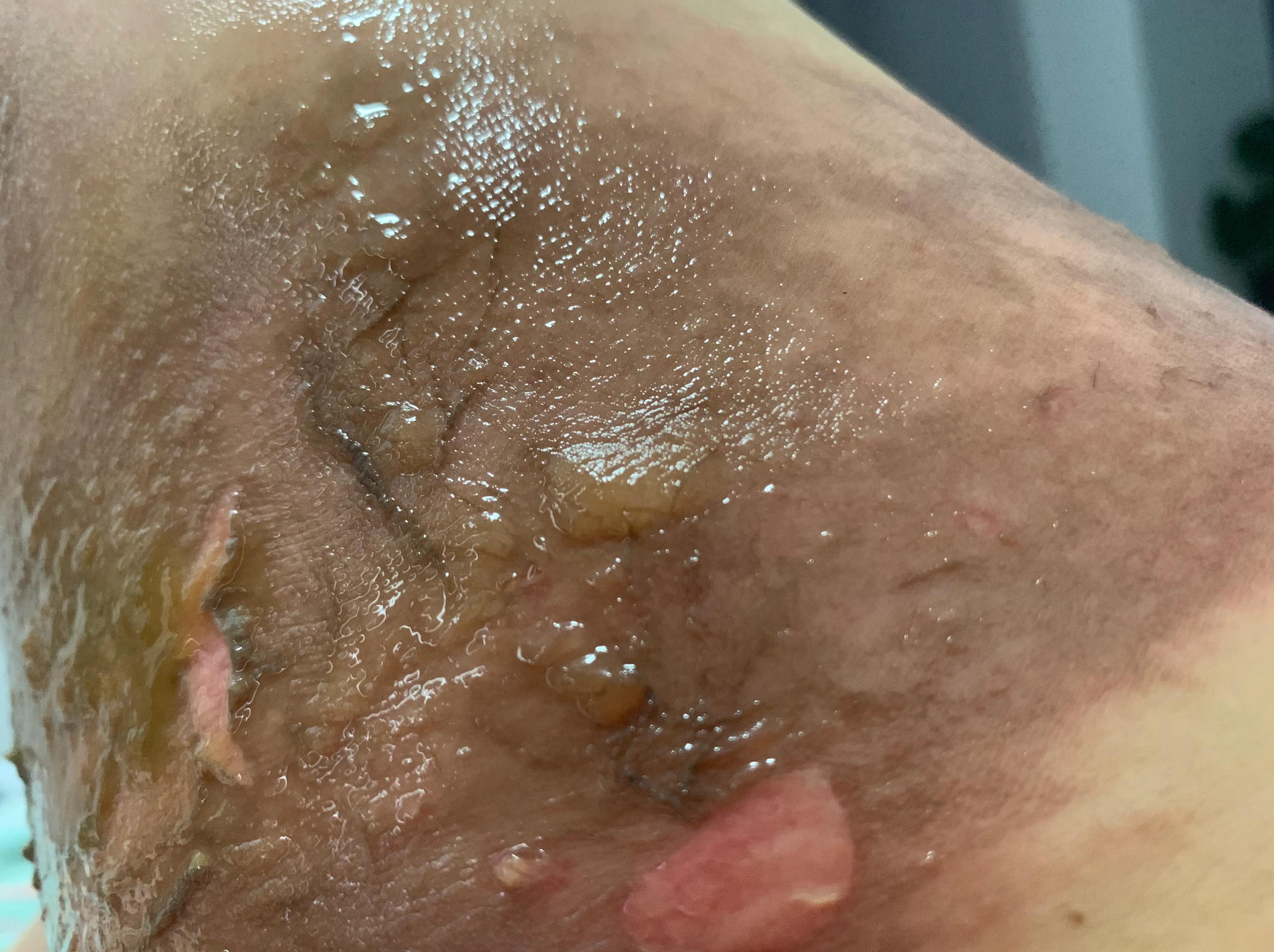 浅二度烫伤14天恢复图片,宝宝浅二度烫伤多久能恢复正常