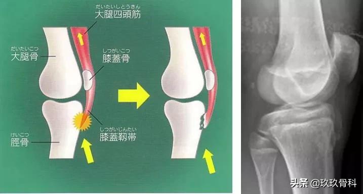青少年膝盖疼骨骺炎怎么缓解,胫骨结节骨软骨炎怎么缓解疼痛